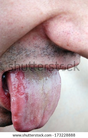 Bacterial infection disease tongue in a young man