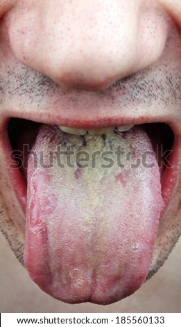 Disease  infection tongue, throat a man