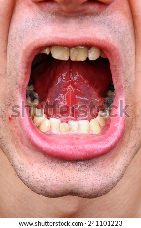 Diseased teeth of the patient. Tartar and tooth decay