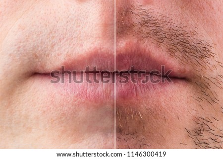 The result on the mans face after shaving, before and after. Effect of after shave cream. Hair transplantation on the beard. Close-up