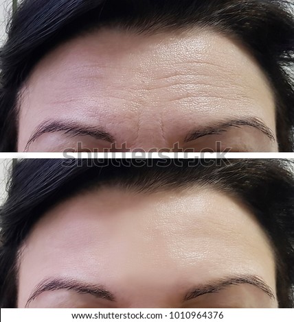 forehead women wrinkles before and after