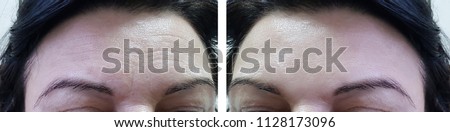 face woman forehead wrinkles before and after cosmetic procedures