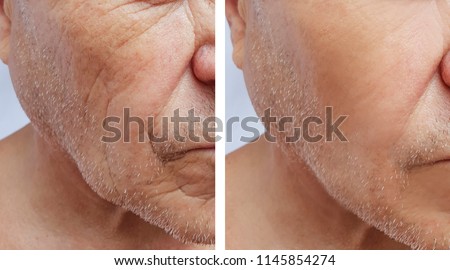 face of an elderly man wrinkles face before and after procedures