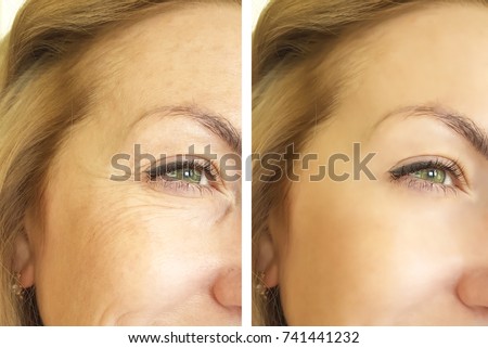 eye wrinkles before and after