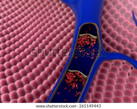 artery  with a fatty plaques and erythrocytes, Contraction of blood vessels, a blood clot in the vessels, fat cell in the blood, High quality 3d render of blood cells, cholesterol in a blood