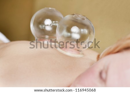 vacuum cupping treatment to patients back