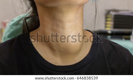 Neck of a young Asian woman in black shirt with enlarged thyroid gland