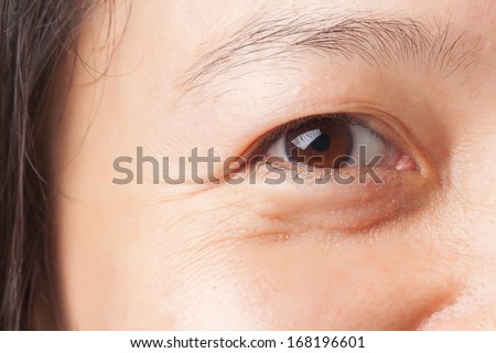 Woman wrinkles and under eye bag