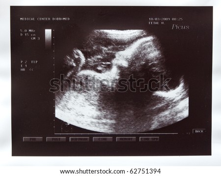 Girl fetus 7 month in the womb. Visible head and arms