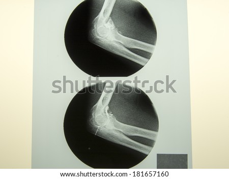 X-RAY of a needle in elbow during a surgery with radioactive element to destroy blood vessels that cause the bleeding in the joint.