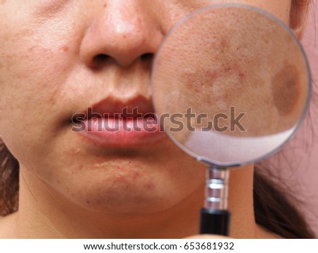 Close up melasma skin by magnifying glass on woman face, facial scar, melasma skin, skin problem, beauty concept