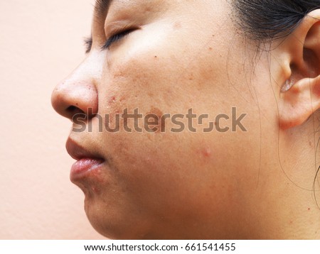 Melasma on woman face, Skin problems, unhealthy skin, Beauty and cosmetics concept