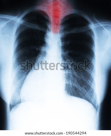 Film X-ray, show throat pain