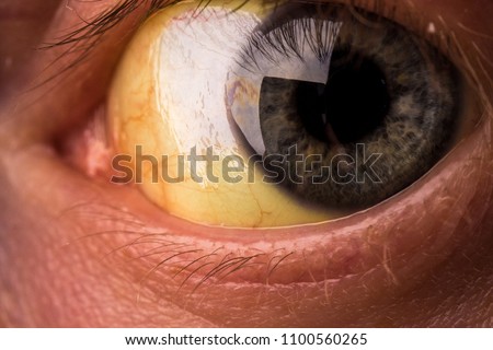 patient with jaundice. close-up shot of yellowed eyes. severe form of Hepatitis. medical concept. life and health.