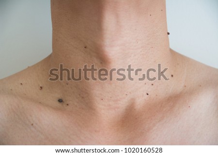 Mole or wart on the men skin