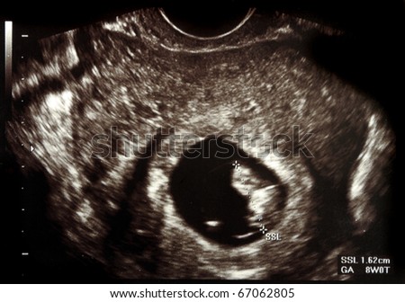 Ultrasound scans during pregnancy in the ninth week