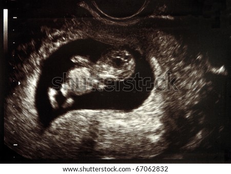 Ultrasound scans during pregnancy in the eleventh week
