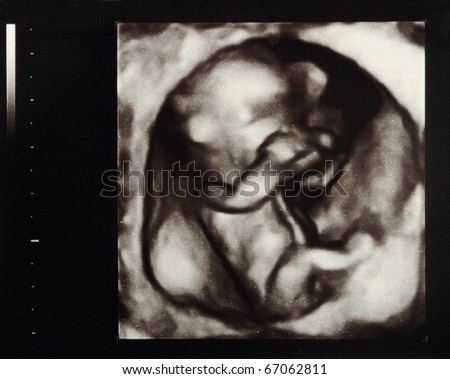 Ultrasound scans during pregnancy in the thirteenth week