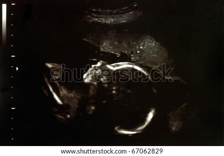 Ultrasound scans during pregnancy in the twentythird week