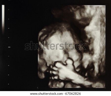 Ultrasound scans during pregnancy in the twentythird week