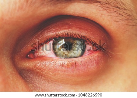 red eye of a patient with human conjunctivitis, retro toned