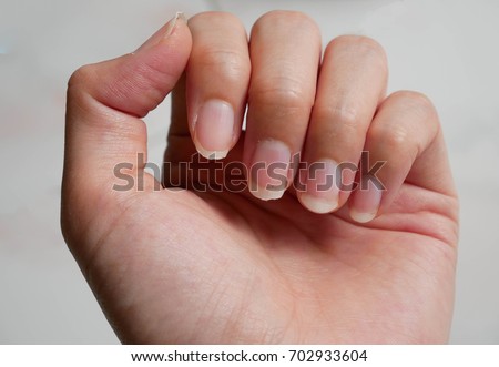 fingernail lack of nutrients and do not make nail not shape and not care, this image can be use for health care concept