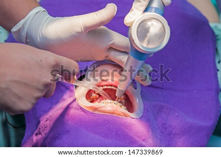 An extreme close-up of a dental patient having her teeth cleaned and polished by the dentist with dental assistant.