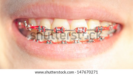 Close-up of a happy teenage girl smiling with braces