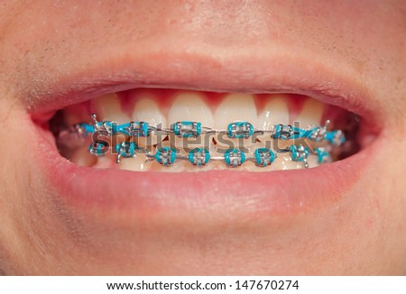 Close-up of a happy teenage boyl smiling with braces