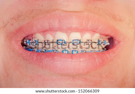 Close-up of a happy teenage boy smiling with braces