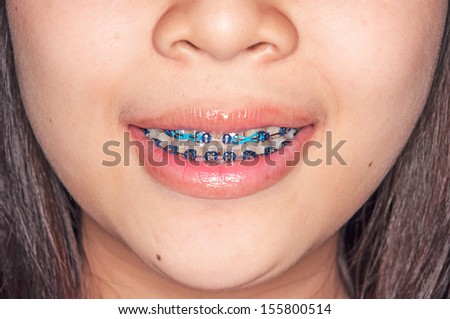 Close-up of a happy teenage girl smiling with braces