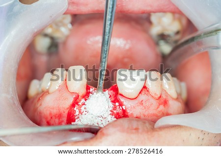 Dental implants surgery in real patient
