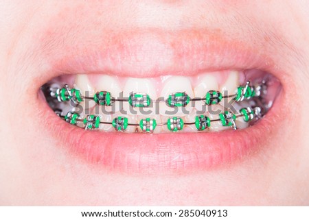 Close Up on braces and white teeth of smiling girl