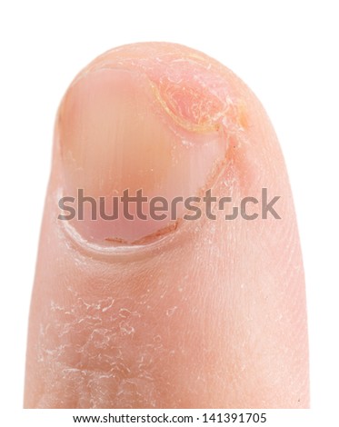 Finger cut with knife, three weeks after injury, isolated on white background