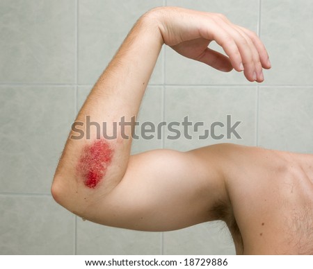 Scraped elbow - the result of inline skating accident. The wound is covered with antibacterial gel