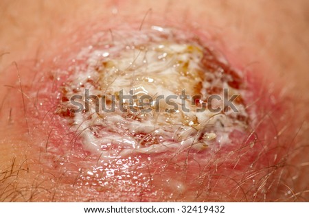 Wound covered with antibacterial gel. It\'s not a makeup