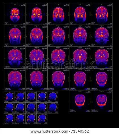 Real brain MRI slide of a girl. Patient\'s and clinics names cloned out, minimal editing to save fine details