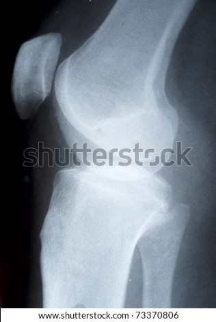 Knee joint x-ray film slide, side view