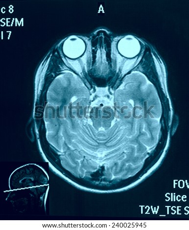 Real brain MRI slide of a young woman. Patient\'s and clinics names cloned out