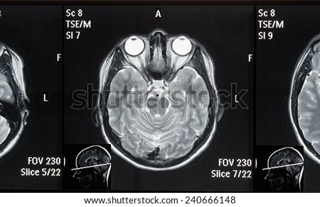 Real brain MRI slide of a young woman. Patient\'s and clinic\'s names removed