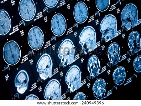 Head and neck MRI scan, patient\'s and clinic\'s info removed, toned image