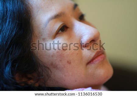 The skin problem of 40s Asian woman.Brownish colored patches or melasma appear on the cheeks. It typically occurs on the face and is symmetrical, with matching marks on both sides of face.