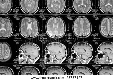 black and white head magnetic resonance image