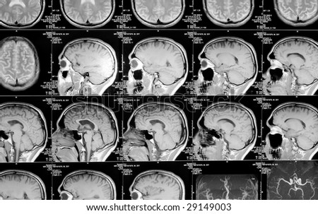 black and white head magnetic resonance image