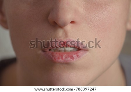 Dermatillomania skin picking. Woman has bad habit to pick her lips. Harmful addiction based on anxiety stress and dry lips. Excoriation disorder. Sick cracked damaged tissue.