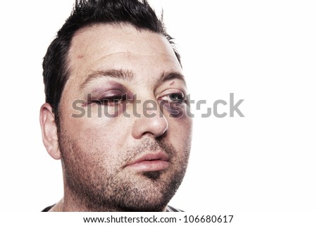eye injury, male with black eye isolated on white. man after accident or fight with bruise