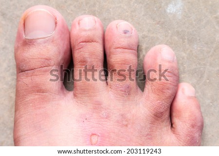 closeup skin athlete's foot psoriasis fungus, hong kong foot, foot disease