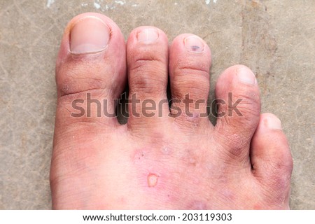 closeup skin athlete\'s foot psoriasis fungus, hong kong foot, foot disease