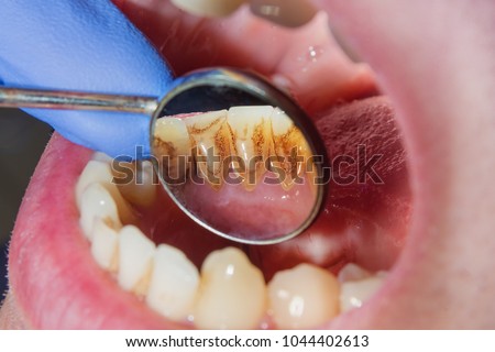Dental caries. Filling with dental composite photopolymer material using rabbders. The concept of dental treatment in a dental clinic