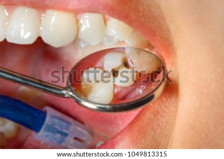 Dental caries. Filling with dental composite photopolymer material using rabbders. The concept of dental treatment in a dental clinic